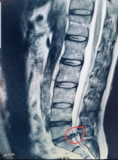 "فيصل الطائف" يُجري عملية بالميكروسكوب لأربعيني أسفل الظهر