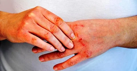 في اليوم العالمي للصدفية.. استثمار الجهود لرفع مستوى الوعي المجتمعي بالمرض