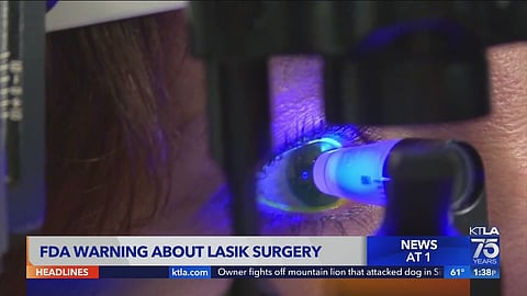 جراحة العيون بتقنية الليزك