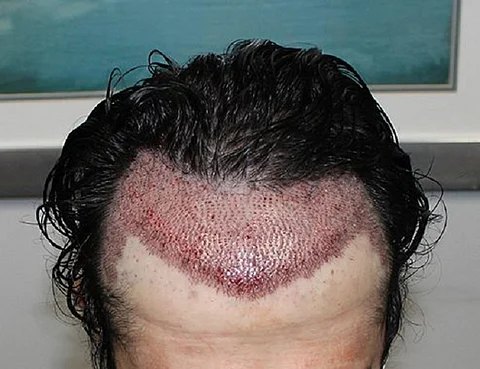 احذروا غيرَ المتخصصين.. هذا ما حدث لشاب أثناء عملية "زرع شعر"