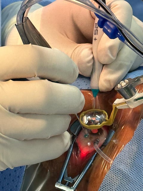 عملية جراحية لمريض يعاني من نزيف في الشبكية مع وجود تليفات