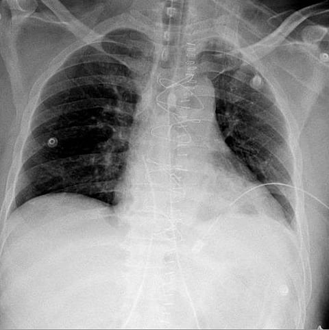 استرواح ونقل عاجل للعمليات.. "سعود الطبية" تنقذ مقيمًا تعرض لإصابة نافذة في القلب