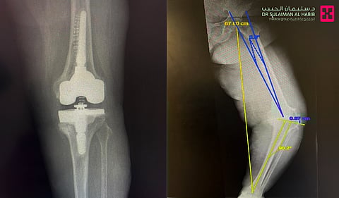 مستشفى سليمان الحبيب بالخُبر يُعيد الحركة إلى سبعينية بعد معاناة 10 سنوات