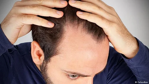 عن الصلع المبكر لدى الرجال.. دراسة تكشف سببًا لا يتوقّعه كثيرون!
