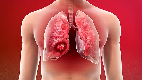 هذه الأعراض دلالة على أكثر أنواع السرطانات خطورة.. انتبه لها