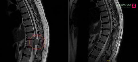 مركز جراحات المخ والأعصاب والعمود الفقري بمجمع الدكتور سليمان الحبيب بالعُليا يُعيد قدرة خمسينية على المشي مجدّداً