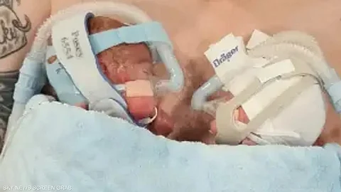 معجزة حقيقية.. هذا ما حدث لتوأمين وُلِدا في الشهر السادس