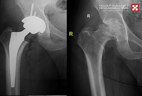 مجمع الدكتور سليمان الحبيب بالعليا يستبدل مفصل الورك لأربعيني بتكنيك حديث ويُعيد له قدرةَ المشي الطبيعية مجددًا