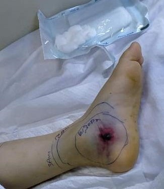 الأردن.. لدغة أفعى تتسبب بإدخال طفل للعناية الفائقة