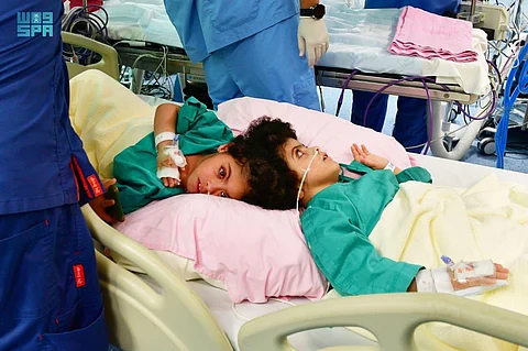 نجاح فصل السيامي المصري "سلمى وسارة" بعد عملية معقدة استغرقت 17 ساعة
