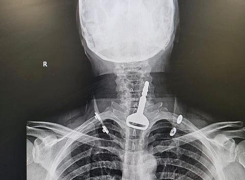 القنفذة.. تدخّل جراحي يُنقذ حياة مريض ابتلع مفتاح سيارته