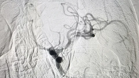 تجمع صحي حائل ينقذ مقيمًا مصريًّا تعرّض لجلطة دماغية حادّة