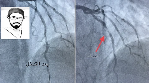 جلطة بعد 4 أشهر.. استشاري: لا تتوقف عن المسيلات بعد إجراء توسيع الشرايين
