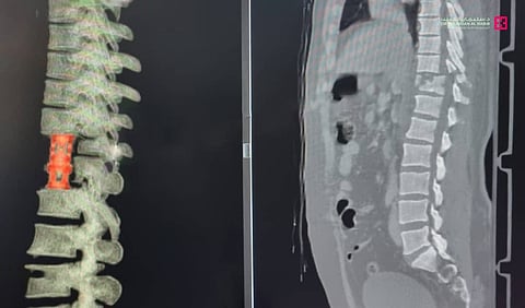 مستشفى الدكتور سليمان الحبيب بالقصيم يعيد الحركة لشاب أصيب بـ"الشلل" إثر سقوطه من علو شاهق