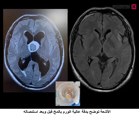 مركز جراحة المخ والأعصاب بمجمع الدكتور سليمان الحبيب بالعليا ينقذ حياة "أربعيني" مصاب بورم في عمق الدماغ