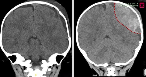 مستشفى الدكتور سليمان الحبيب بالريان ينجح في إنقاذ رضيع مصاب بكسر بالجمجمة ونزيف حاد بالدماغ