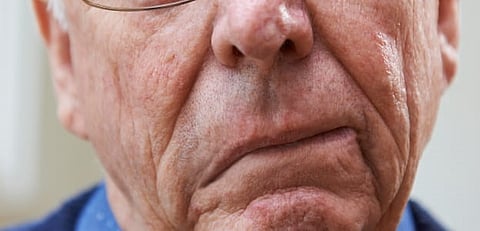 هذه أسبابها.. زيادة كبيرة منتظرة بوفيات السكتة الدماغية