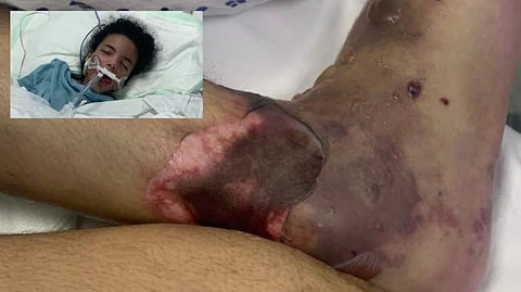 انسلاخ وتجلط في قدم "الطفلة ابتهال" بعد خروجها من "العناية".. وأسرتها تطالب بالتدخل