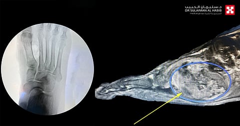 مجمع الدكتور سليمان الحبيب بالعليا يستأصل ورما نادرا من قدم "خمسيني" بجراحة دقيقة