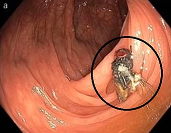 منظار للقولون ينتهي بمفاجأة محيرة.. شاهد ما عثر عليه الأطباء في أمعاء رجل أمريكي