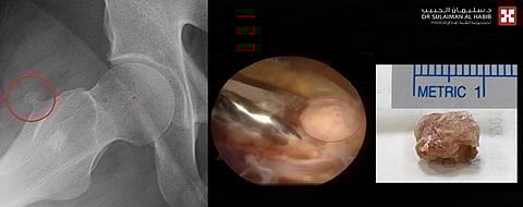 مجمع الدكتور سليمان الحبيب بالعليا يُعيد لأربعيني قدرته الطبيعية على المشي مجدداً بعد استئصال ورم بالورك