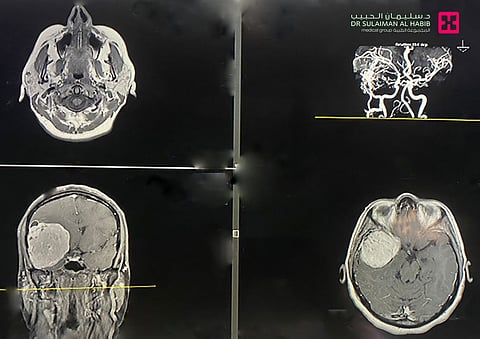 بمجمع الدكتور سليمان الحبيب في العليا.. عملية الـ"10" ساعات تنهي معاناة "أربعينية" مع ورم ضخم خلف العينين