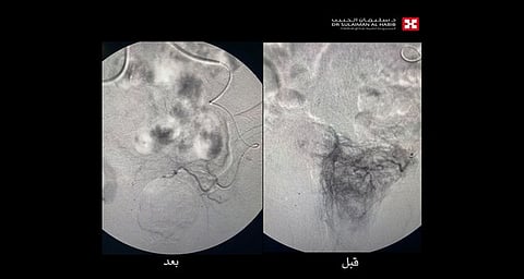 مستشفى الدكتور سليمان الحبيب بالقصيم يُنهي معاناة ستيني خلال ساعتين من مضاعفات تضخم البروستاتا