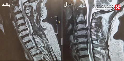 مستشفى الدكتور سليمان الحبيب بالريان يُنهي معاناة ستيني من نوبات ألم بالرقبة وصعوبة في المشي استمر لسنوات