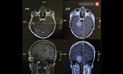 مركز جراحة المخ والأعصاب بمجمع الدكتور سليمان الحبيب بالعليا يُنهي معاناة أربعينية مع "ورم" كبير ضاغط على جذع الدماغ