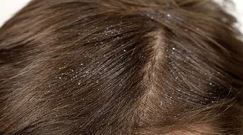 مرض مزمن وانتكاسي.. طبيبة متخصّصة: 5 أسباب لظهور قشرة الرأس