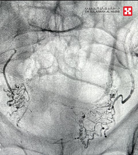مستشفى الدكتور سليمان الحبيب بالقصيم يُجري جراحة متقدمة لإنهاء معاناة ثمانيني مع نزف البروستاتا خلال "90" دقيقة