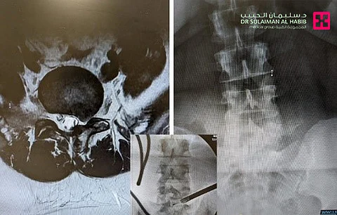 مستشفى الدكتور سليمان الحبيب بالريان ينجح في علاج عشرينية مصابة بانزلاق وتشوه خلقي بعملية منظار دقيقة