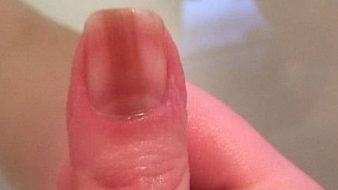 انظر إلى أظافرك.. "سرطان عدواني" تشير إليه علامة محملة بالتداعيات