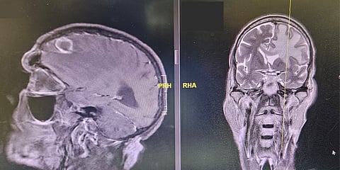 جراحة عاجلة بمجمع فيصل تنقذ مريضاً ثمانينياً من تدهور مفاجئ في الوعي