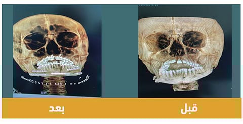 واصلت إنجازاتها في مجال الوجه والفكين.. جراحة معقّدة لعلاج كسور بالفك السفلي لثلاثيني بـ "سعود الطبية"