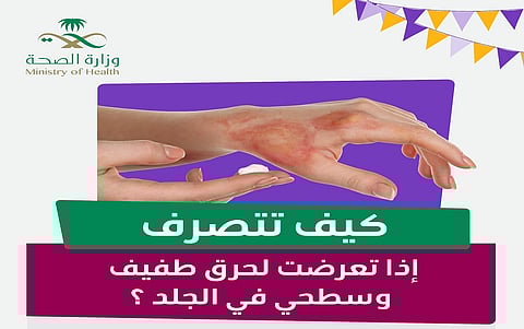 4 نصائح وتجنّب مثلها.. كيف تتصرف إذا تعرضتَ لحرق سطحي وطفيف؟