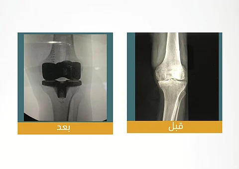 إنجاز غير مسبوق.. أول عملية لاستبدال مفصل الركبة عبر جراحة "اليوم الواحد" بـ"سعود الطبية"