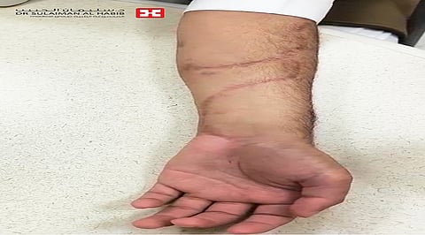مستشفى الدكتور سليمان الحبيب بالريان يُنقذ عشريني من بتر ذراعه نتيجة لحادث سير