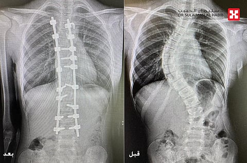 مستشفى الدكتور سليمان الحبيب بالعليا ينهي معاناة فتاه مع "جنف شديد" وبروز القفص الصدري خلال 6 ساعات