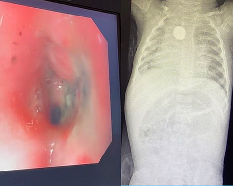 سابقة نادرة دون تدخل جراحي.. استخراج بطارية حارقة من مريء طفلة بـ "ولادة مكة"