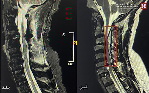 مستشفى الدكتور سليمان الحبيب بالعليا يستأصل ورماً ضاغطاً على الحبل الشوكي مسبباً شللاً رباعياً لستيني
