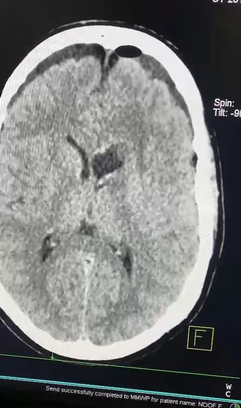 جراحة استباقية عاجلة تُنقذ مريضًا من ورم مؤكّد في "تخصصي الطائف"