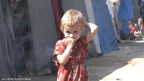 مستشفى كمال عدوان شمال غزة يسجل عشرات حالات سوء التغذية بين الأطفال