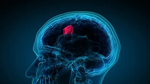 لا تتجاهلها.. هذه الإشارة هي أكثر أعراض سرطان الدماغ شيوعًا