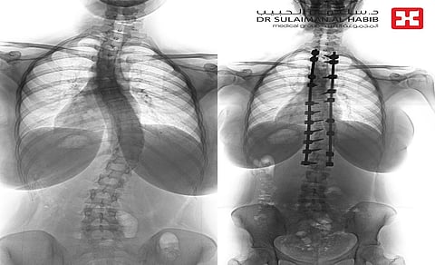 مستشفى الدكتور سليمان الحبيب بالفيحاء في جدة ينهي معاناة شابة مع انحراف في العمود الفقري