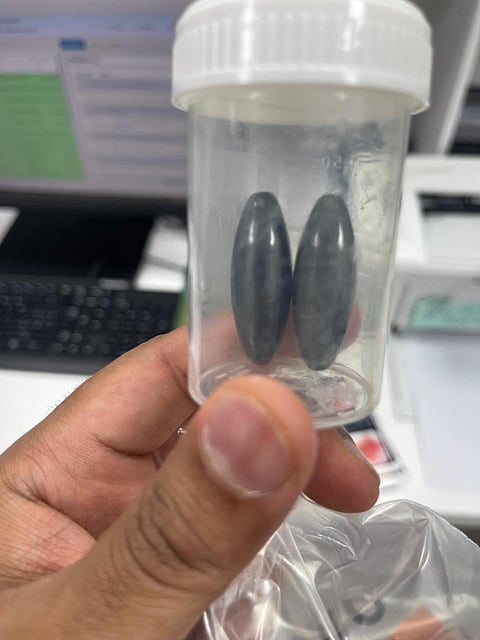 استخراج زوج مغناطيسي كبير الحجم من أمعاء طفل بجازان