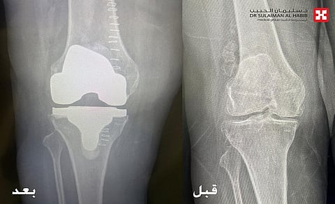 مجمع الدكتور سليمان الحبيب بالعليا يُعيد القدرة على المشي لثمانينية تعاني من مرض "نادر" سبّب لها خللًا بالأعصاب الحركية والحسية