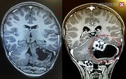 مستشفى الدكتور سليمان الحبيب بالخبر يُنهي معاناة طفل مع ورم متشعب في المخ بتقنيات حديثة