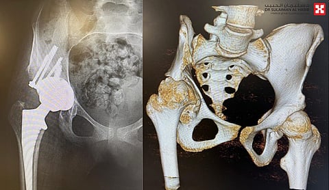 مستشفى الدكتور سليمان الحبيب بالتخصصي يُجري عملية ناجحة لاستبدال مفصل الورك لشابة "كويتية"