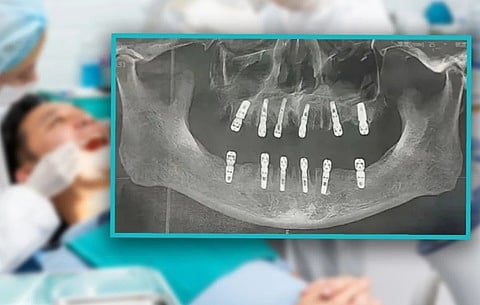 صيني خلع 23 سنًّا وزرع 12 في يوم واحد.. وهذا ما حدث له بعد أسبوعَيْن